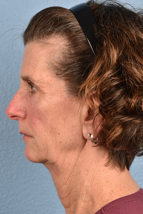 Blepharoplasty Before and After | Cheng Plastic Surgery