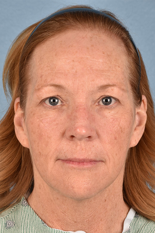 Blepharoplasty Before and After | Cheng Plastic Surgery
