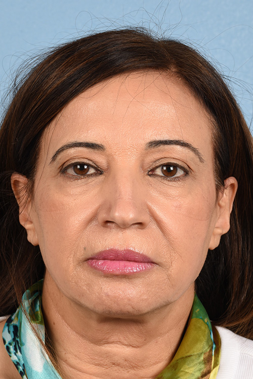 Blepharoplasty Before and After | Cheng Plastic Surgery