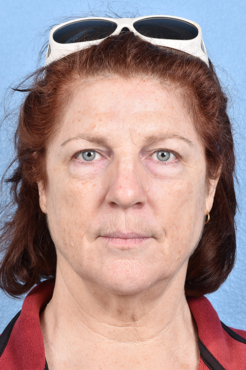 Blepharoplasty Before and After | Cheng Plastic Surgery