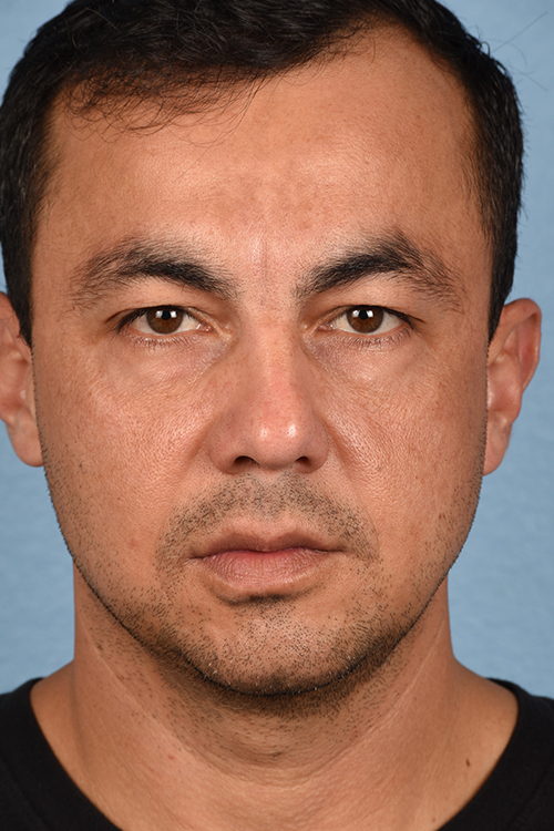 Blepharoplasty Before and After | Cheng Plastic Surgery