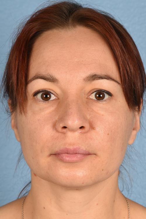 Blepharoplasty Before and After | Cheng Plastic Surgery