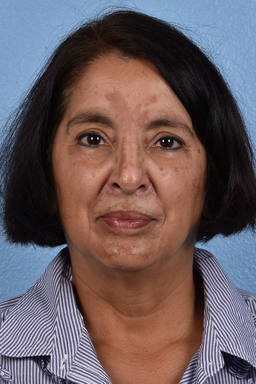 Blepharoplasty Before and After | Cheng Plastic Surgery
