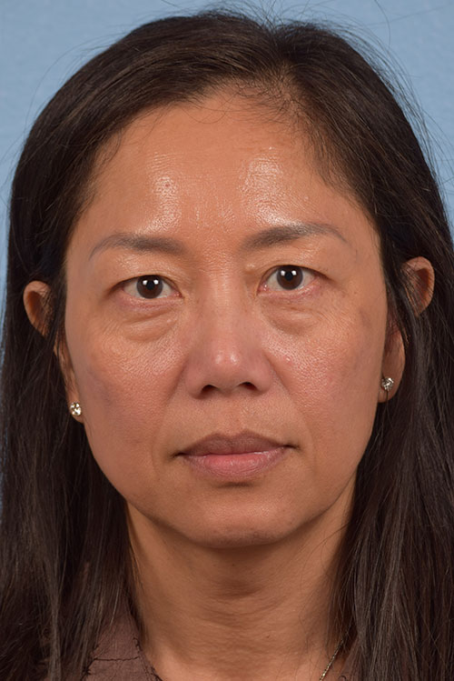 Blepharoplasty Before and After | Cheng Plastic Surgery