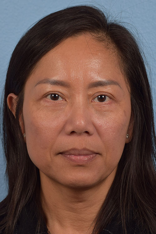Blepharoplasty Before and After | Cheng Plastic Surgery