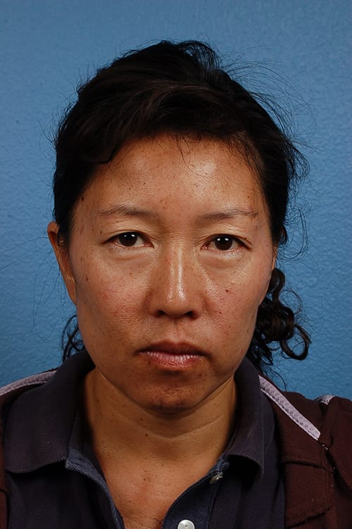 Blepharoplasty Before and After | Cheng Plastic Surgery