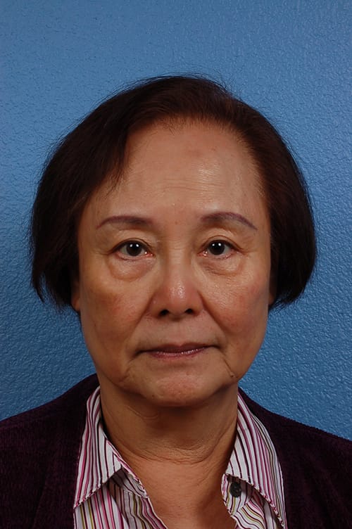 Blepharoplasty Before and After | Cheng Plastic Surgery