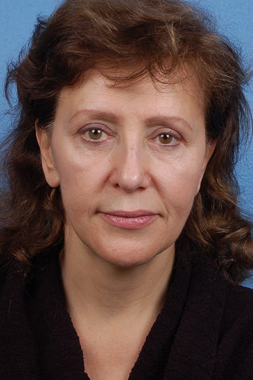 Blepharoplasty Before and After | Cheng Plastic Surgery