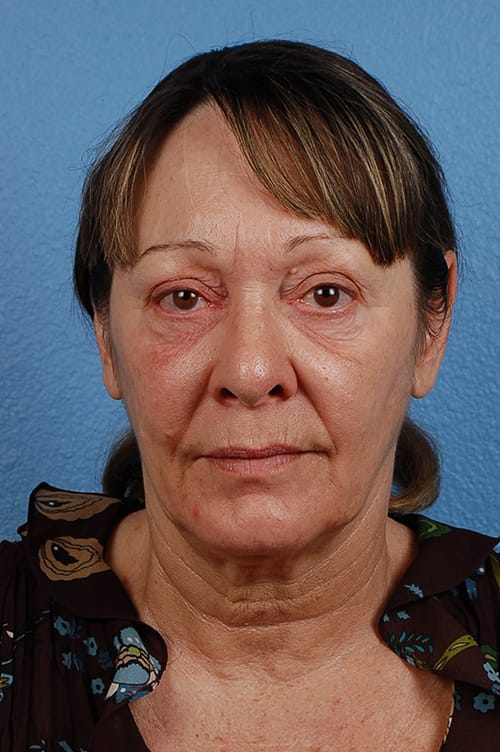 Blepharoplasty Before and After | Cheng Plastic Surgery