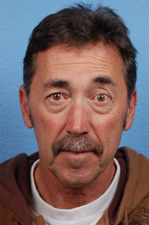 Blepharoplasty Before and After | Cheng Plastic Surgery