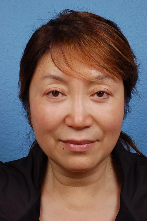 Blepharoplasty Before and After | Cheng Plastic Surgery