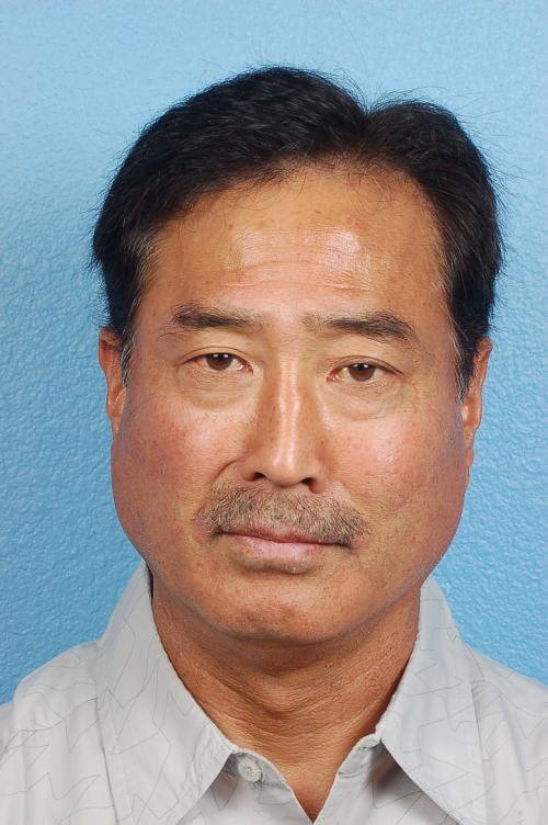 Blepharoplasty Before and After | Cheng Plastic Surgery