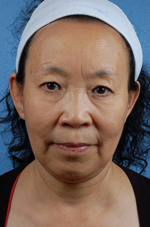 Blepharoplasty Before and After | Cheng Plastic Surgery
