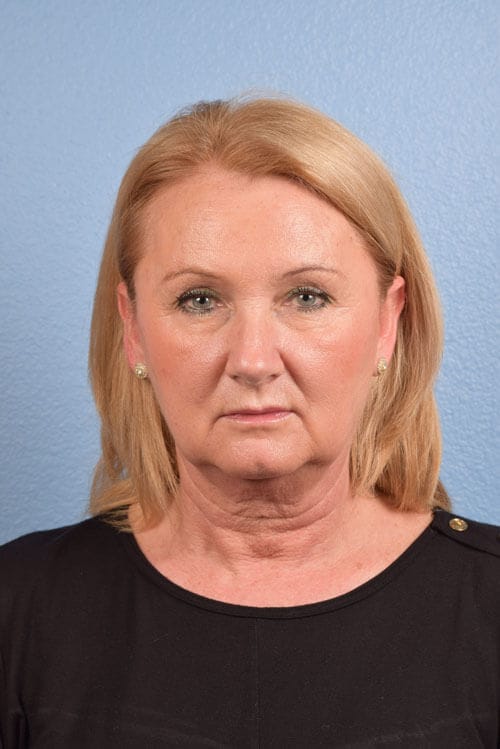 Blepharoplasty Before and After | Cheng Plastic Surgery
