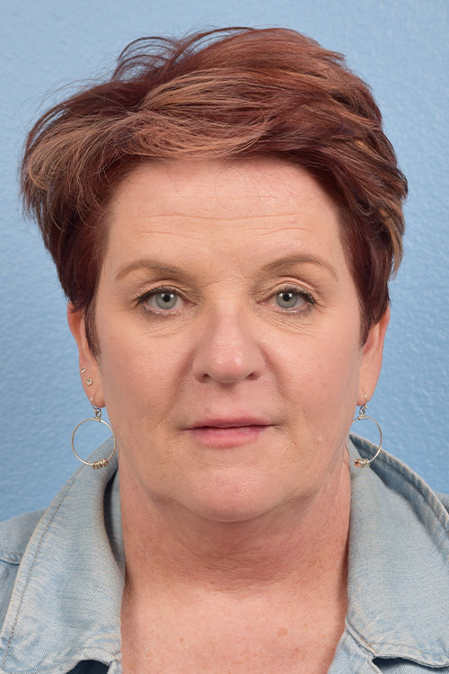 Blepharoplasty Before and After | Cheng Plastic Surgery