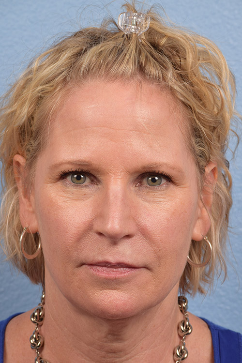 Blepharoplasty Before and After | Cheng Plastic Surgery