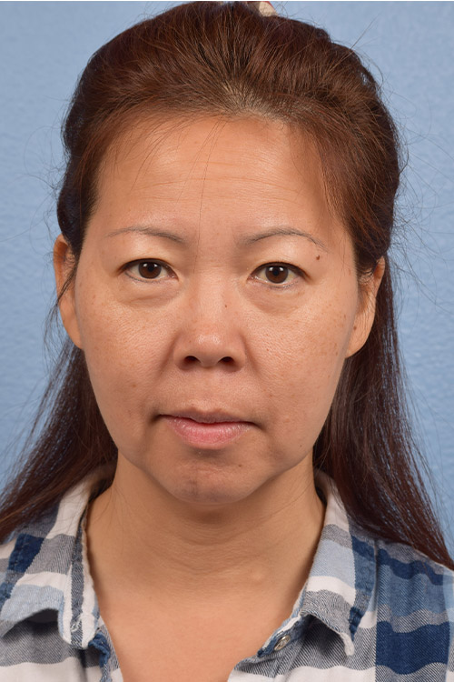 Blepharoplasty Before and After | Cheng Plastic Surgery