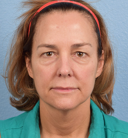Blepharoplasty Before and After | Cheng Plastic Surgery