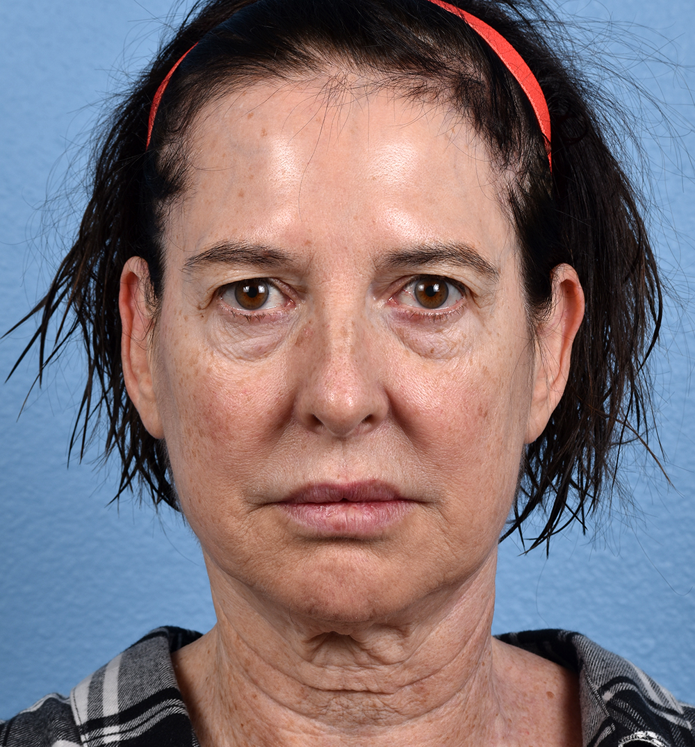 Blepharoplasty Before and After | Cheng Plastic Surgery
