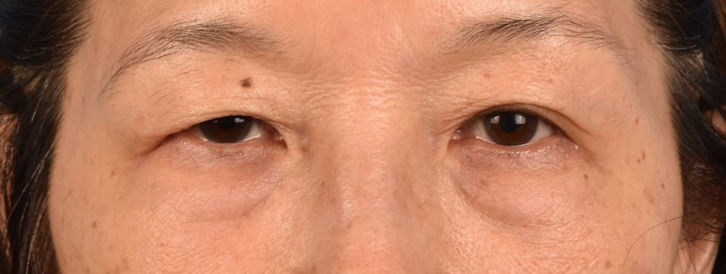 Blepharoplasty Before and After | Cheng Plastic Surgery