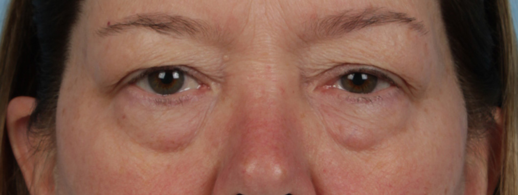 Blepharoplasty Before and After | Cheng Plastic Surgery