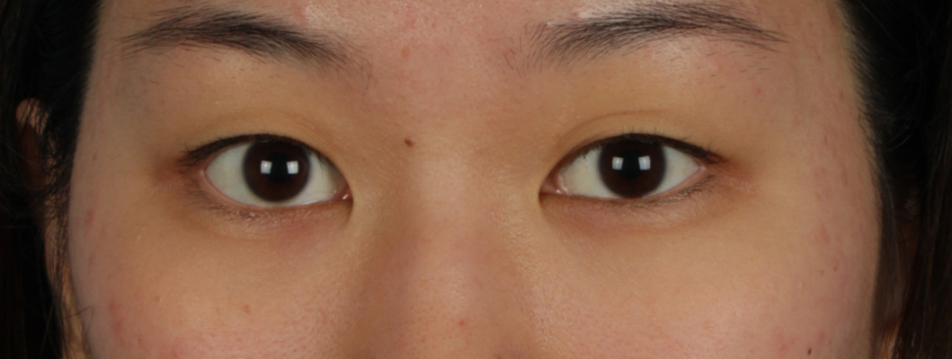 Blepharoplasty Before and After | Cheng Plastic Surgery