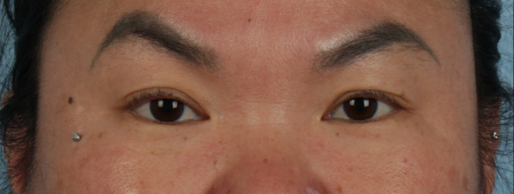 Blepharoplasty Before and After | Cheng Plastic Surgery