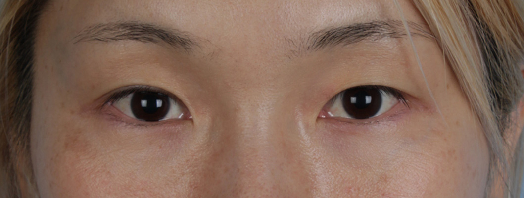 Blepharoplasty Before and After | Cheng Plastic Surgery