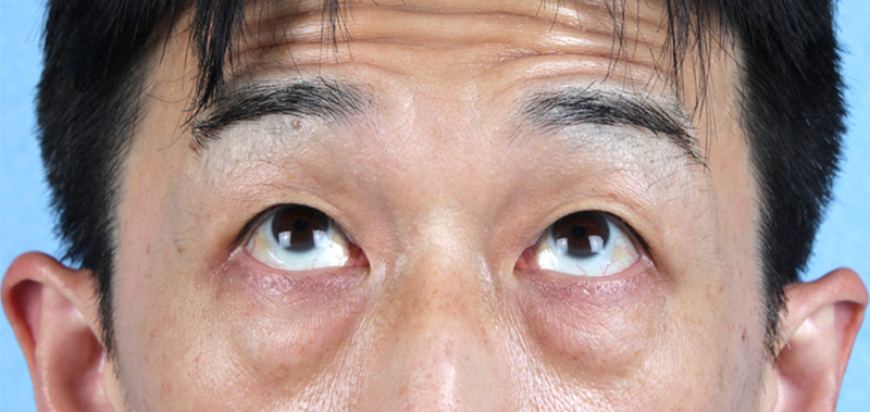 Blepharoplasty Before and After | Cheng Plastic Surgery