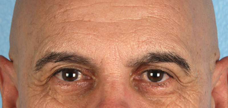 Blepharoplasty Before and After | Cheng Plastic Surgery
