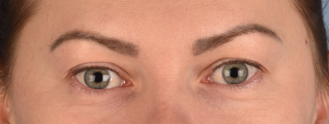 Blepharoplasty Before and After | Cheng Plastic Surgery