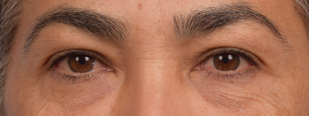 Blepharoplasty Before and After | Cheng Plastic Surgery
