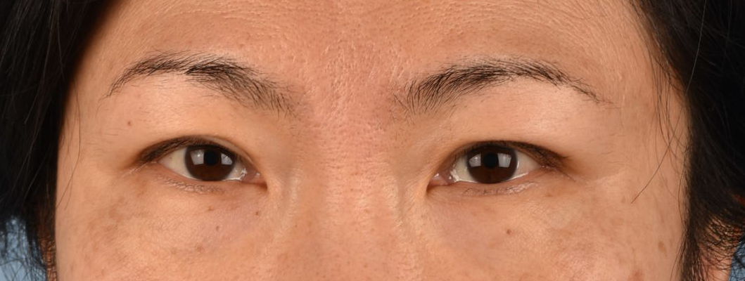 Blepharoplasty Before and After | Cheng Plastic Surgery
