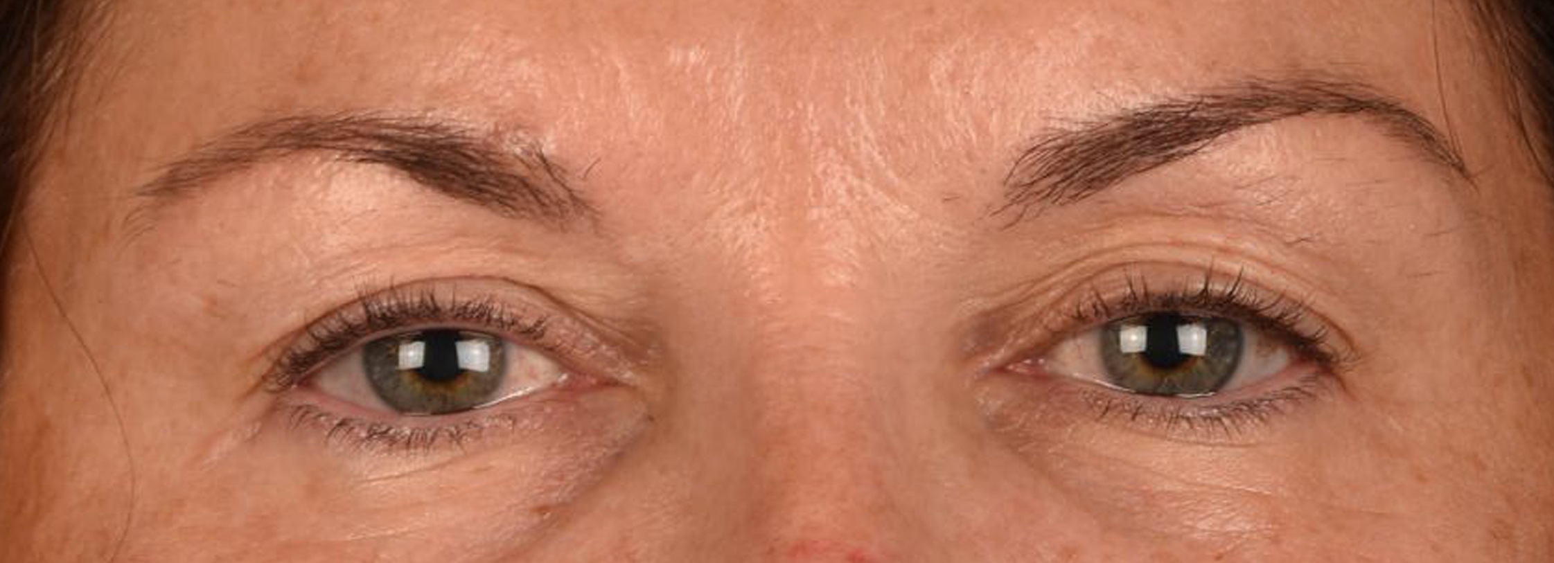 Blepharoplasty Before and After | Cheng Plastic Surgery