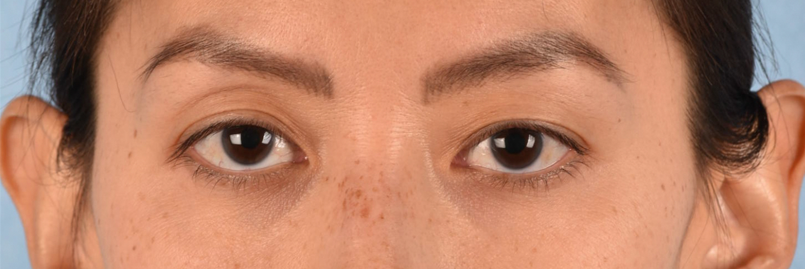 Blepharoplasty Before and After | Cheng Plastic Surgery