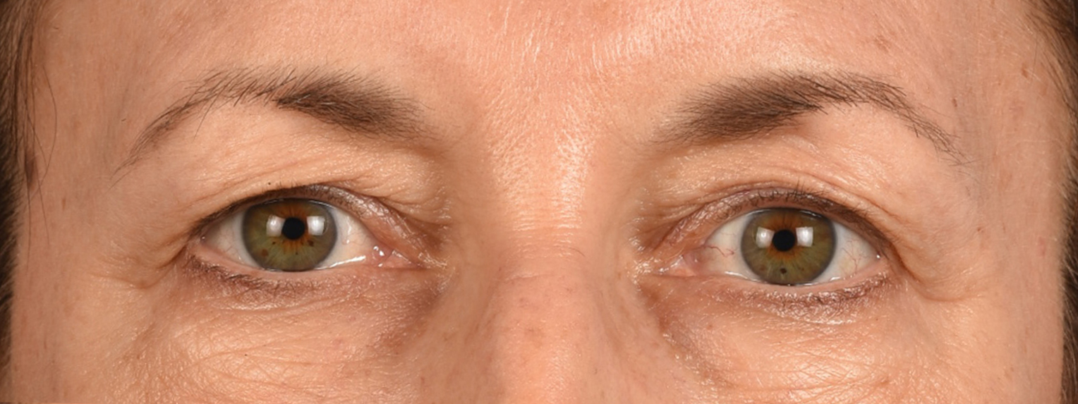 Blepharoplasty Before and After | Cheng Plastic Surgery