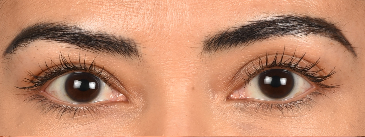 Blepharoplasty Before and After | Cheng Plastic Surgery