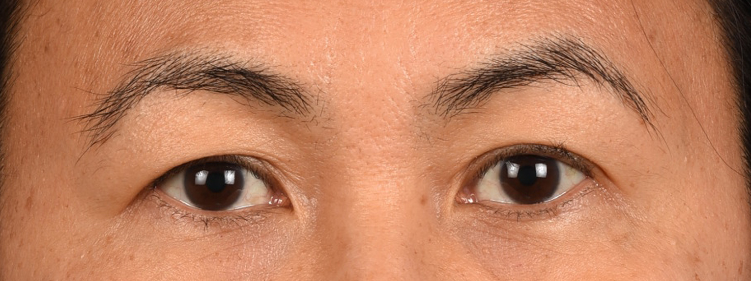 Blepharoplasty Before and After | Cheng Plastic Surgery