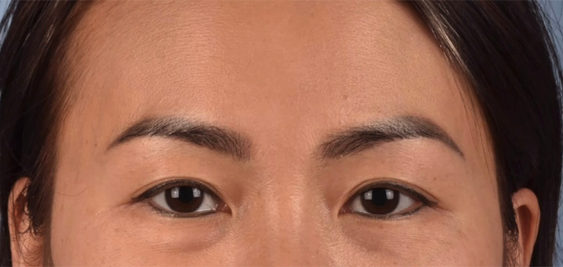 Blepharoplasty Before and After | Cheng Plastic Surgery
