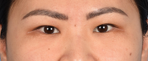 Blepharoplasty Before and After | Cheng Plastic Surgery