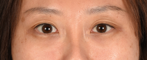 Blepharoplasty Before and After | Cheng Plastic Surgery