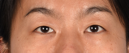 Blepharoplasty Before and After | Cheng Plastic Surgery