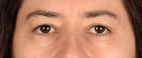 Blepharoplasty Before and After | Cheng Plastic Surgery