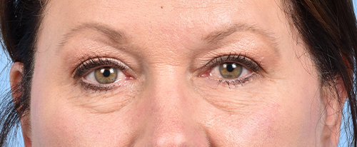 Blepharoplasty Before and After | Cheng Plastic Surgery