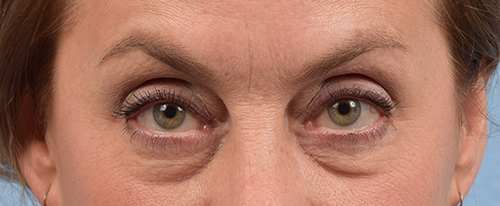 Blepharoplasty Before and After | Cheng Plastic Surgery