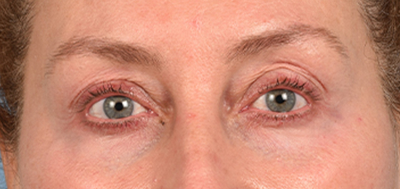 Blepharoplasty Before and After | Cheng Plastic Surgery