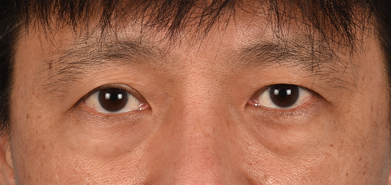 Blepharoplasty Before and After | Cheng Plastic Surgery