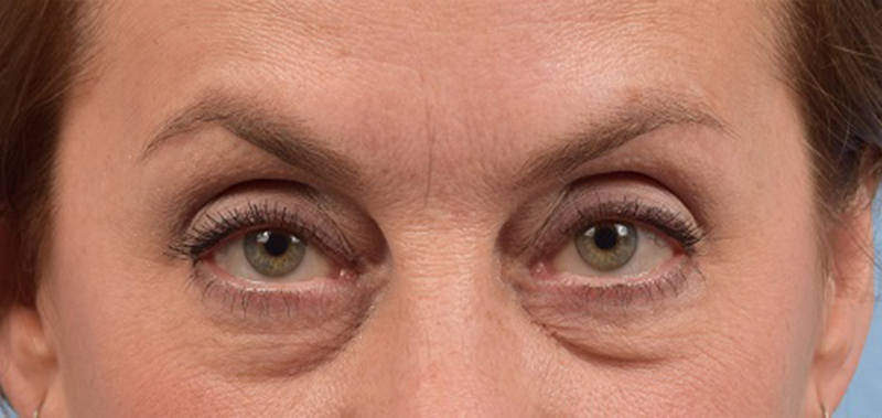 Blepharoplasty Before and After | Cheng Plastic Surgery
