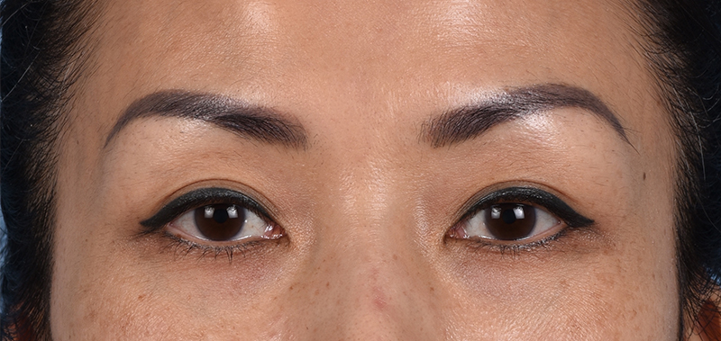 Blepharoplasty Before and After | Cheng Plastic Surgery