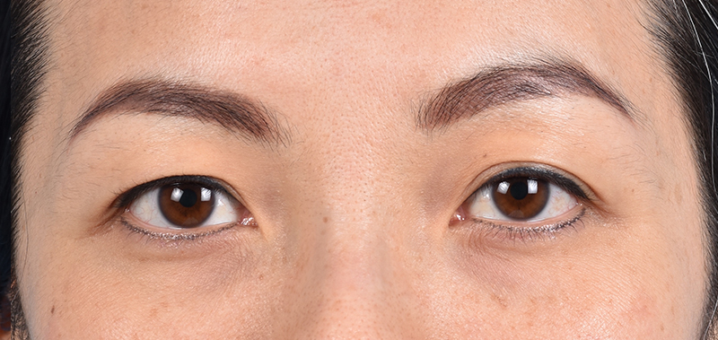 Blepharoplasty Before and After | Cheng Plastic Surgery
